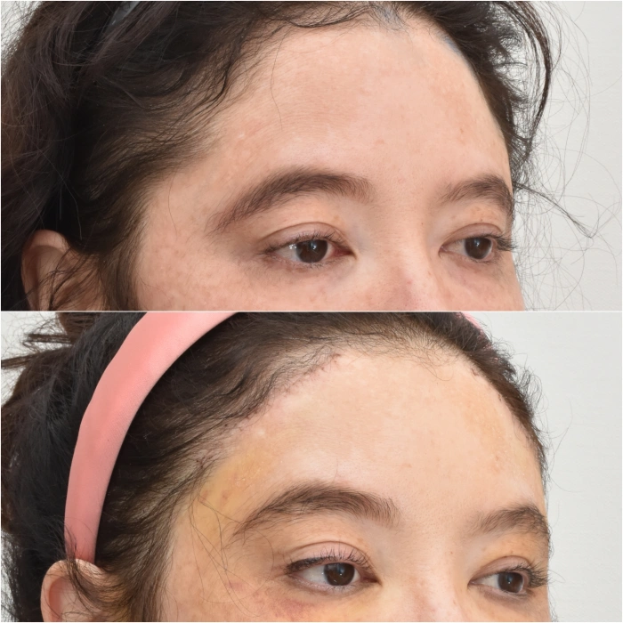 Female fox eye lift cases