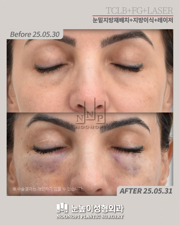 eyebag transposition early recovery
