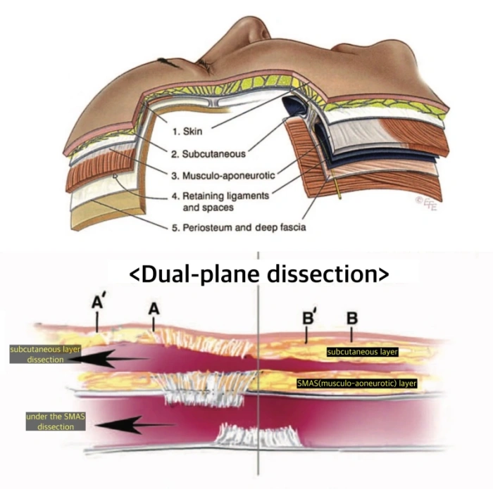 شد الوجه SMAS التقليدي مع تشريح ثنائي المستوى