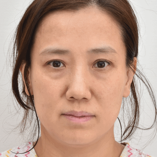 激光眼睑紧致与脂肪重置术后3周