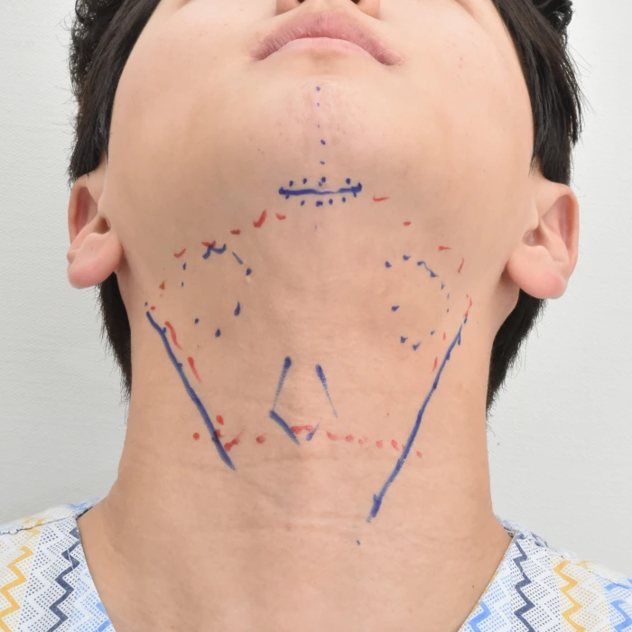 迷你颈部提升术术前标记