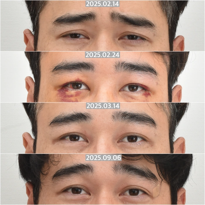 내시경 이마거상 수술 후 회복 과정 및 눈썹 위치 변화