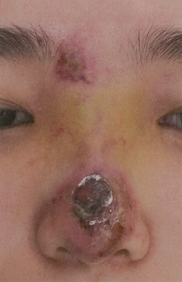 未经治疗的填充剂皮肤坏死(教科书案例)