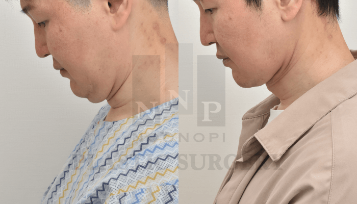심부 목거상과 근육묶기 후 고개를 숙여도 이중턱이 접히지 않는 턱선
