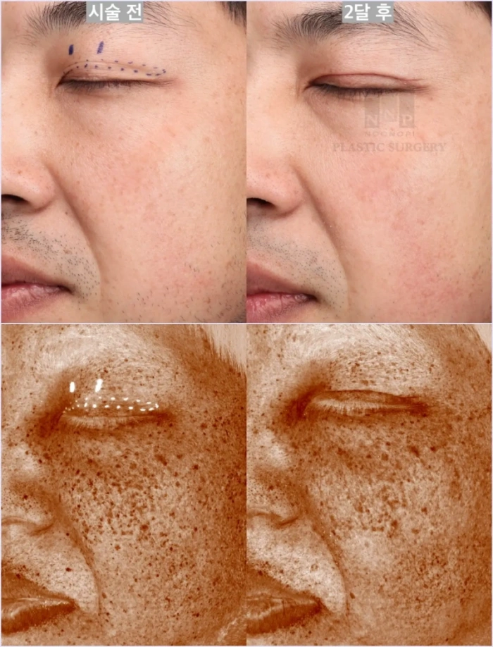 BBL 레이저 전후