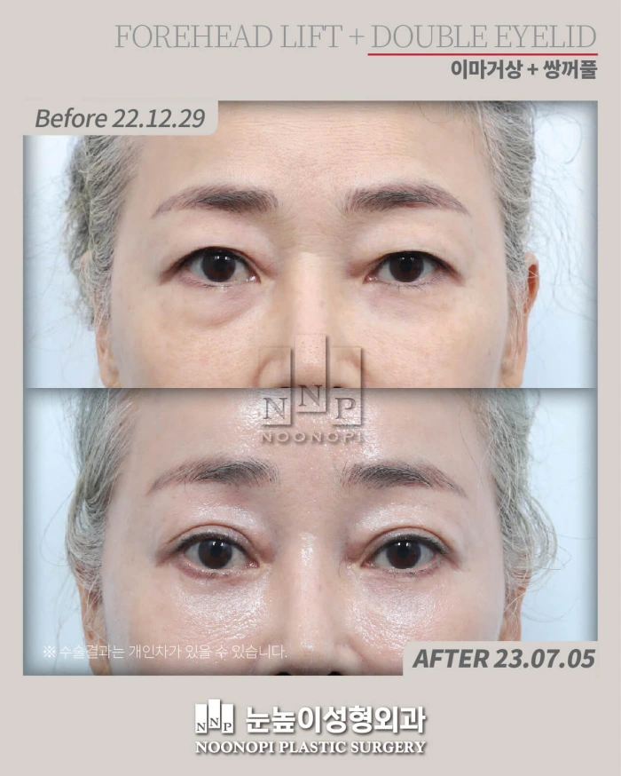 علاج العيون المغطاة برفع الحاجب الداخلي وجراحة الجفن المزدوج