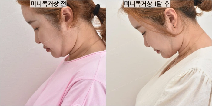 submentoplasty korea