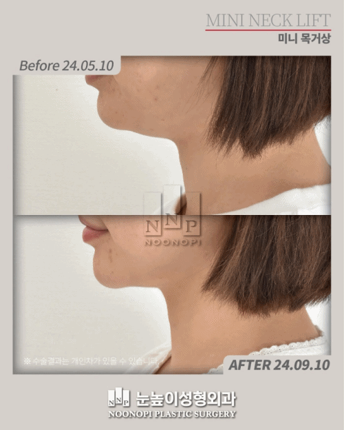 韩国颈部提升效果