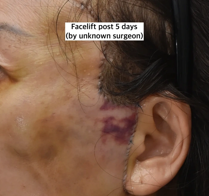 فقدان السوالف بسبب وضع الشق في مكان غير مناسب