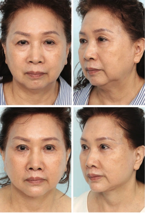 deep plane facelifting poor results