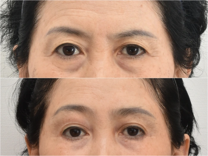 Endoscopic brow lift with lower blepharoplasty, 21 months post-op.