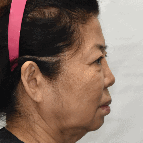 面颈部提升术效果（术后2个月）