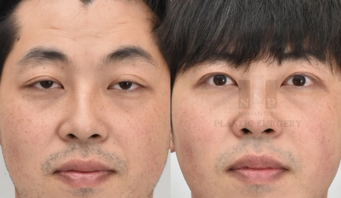 韩国眼睑下垂手术前后对比