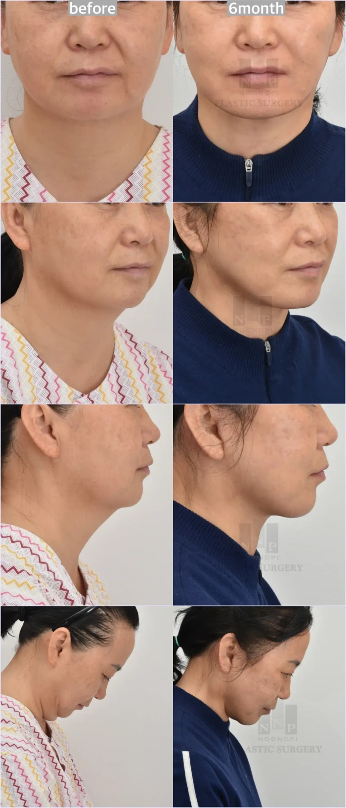 face and neck lift korea before after