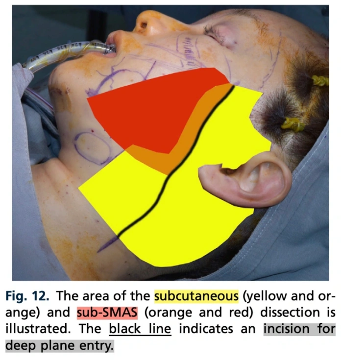 رسم توضيحي لمنطقة التوسيع (رابط مرجعي)