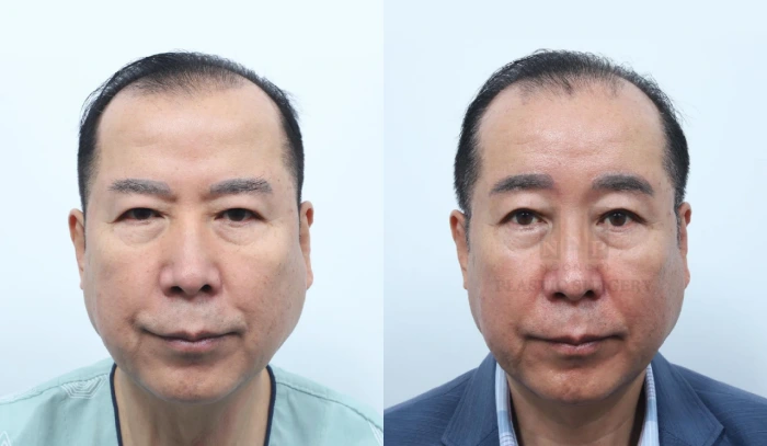대머리 이마거상 전후