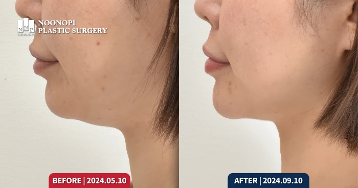 mini neck lift before after in korea