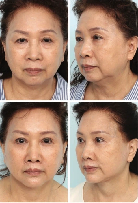 仍可见的下颌赘肉