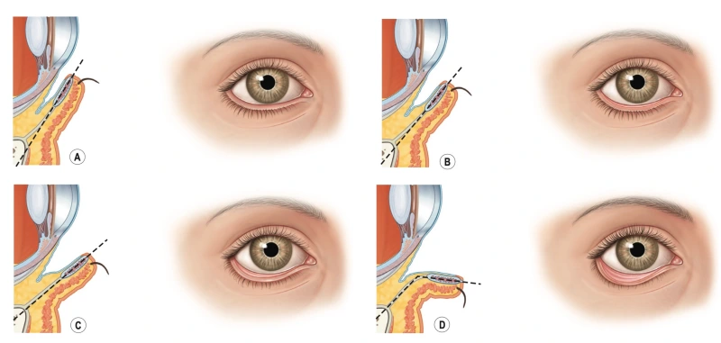 ectropion symptoms