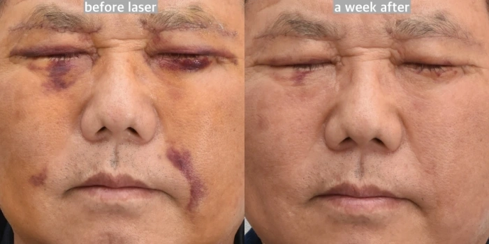 激光治疗术后红斑案例