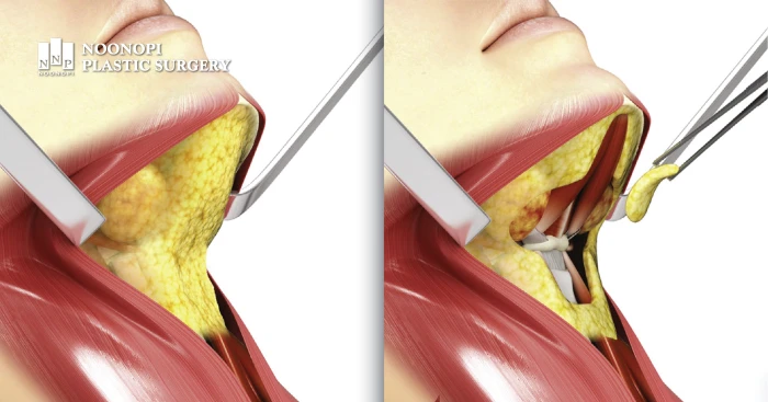 Deep Fat Removal during deep neck lift