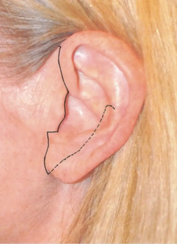 沿耳屏(耳软骨)的切口是众多面部提升专家推荐方案 (摘自《美容外科艺术》)