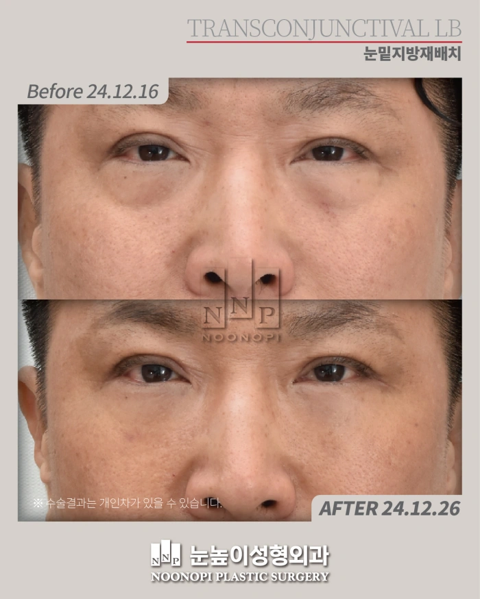 يمكن أن تظل جراحة الجفن السفلي بدون ندبات خيارًا مناسبًا للمرضى في الخمسينات من العمر،  خاصةً عندما يكون الجلد الزائد في الجفن السفلي ضئيلًا