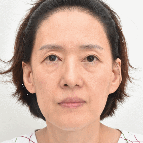 زرع دهون الوجه بالكامل بعد 9 أيام