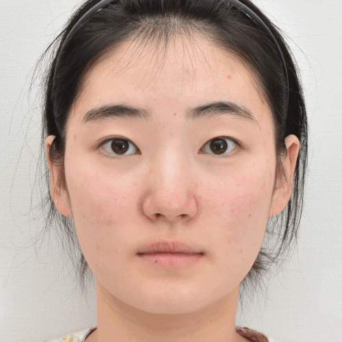 مريض شاب يعاني من تدلي الحاجب:  جراحة الجفن المزدوج بالطريقة غير الجراحية قبل وبعد