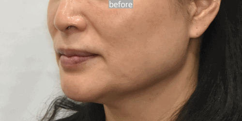 Deep plane facelift before after