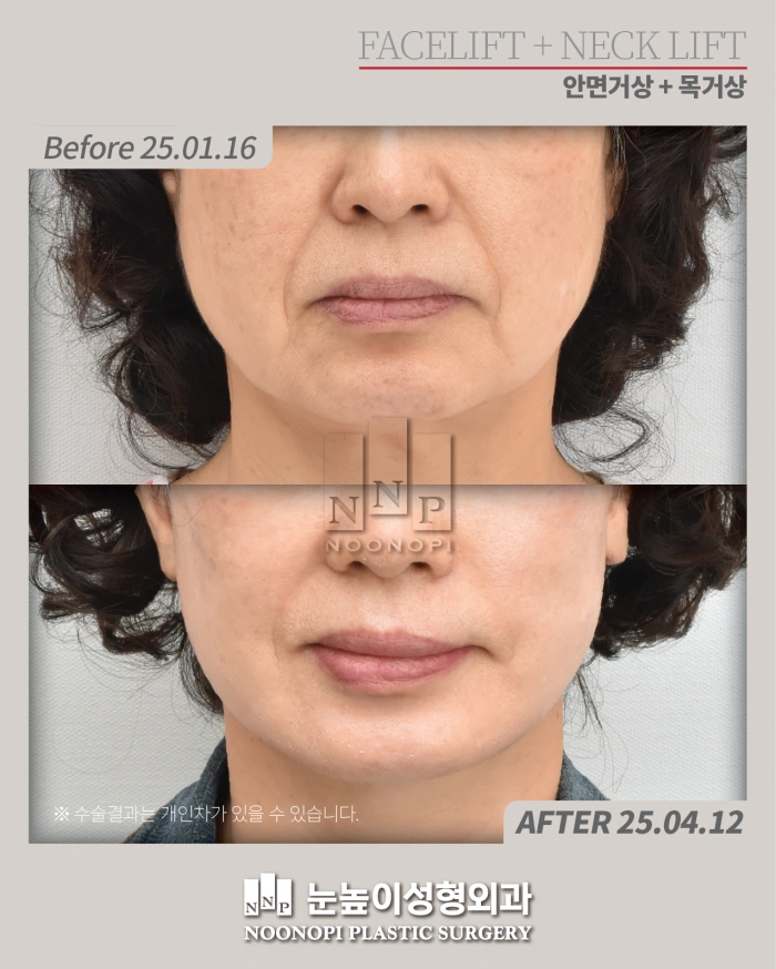 علاج الأنف والشفة العليا مع شد الوجه قبل وبعد