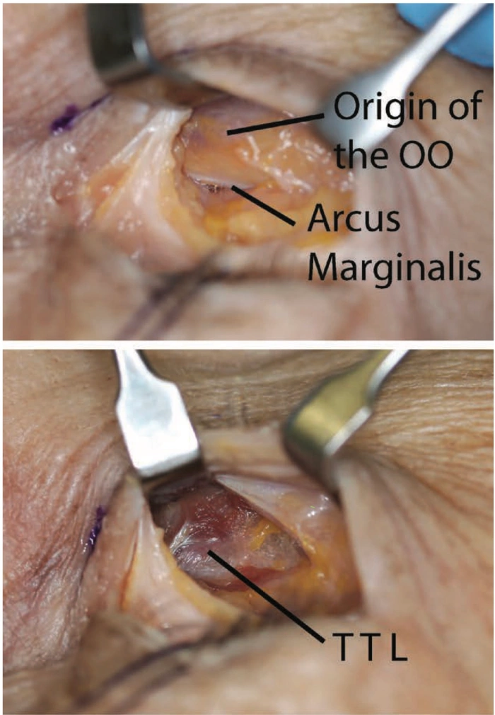 Anatomy around the orbital retaining ligament