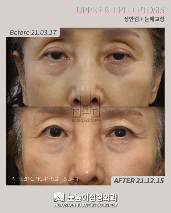 جراحة الجفن العلوي في كوريا
