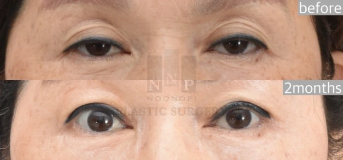 جراحة تدلي الجفون قبل وبعد