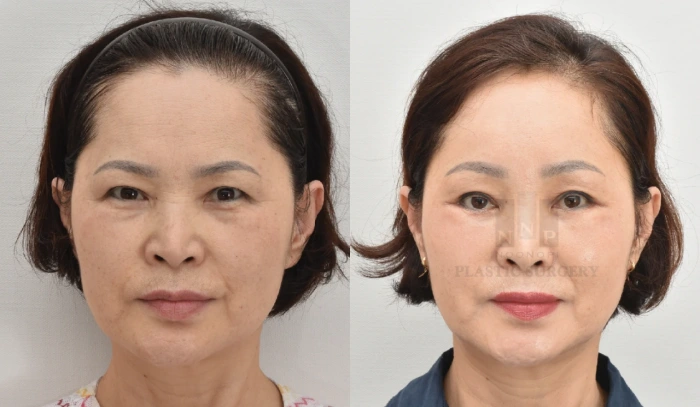 下眉部内提拉术示例