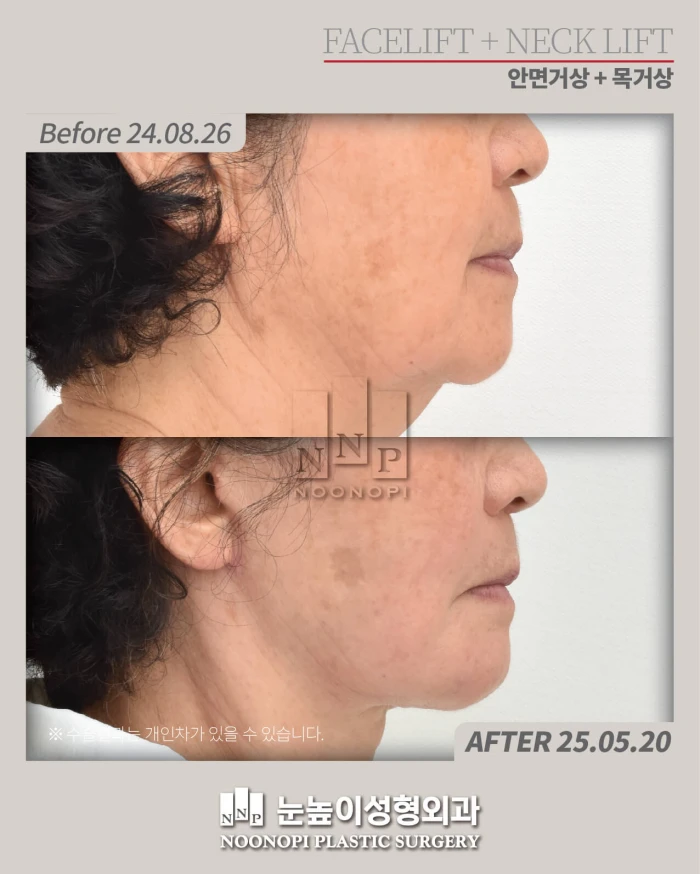 78세 안면거상, 목거상, 이마거상 8달 후 모습