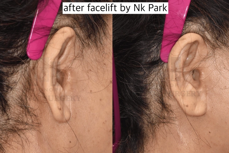 较隐蔽的面部提升疤痕