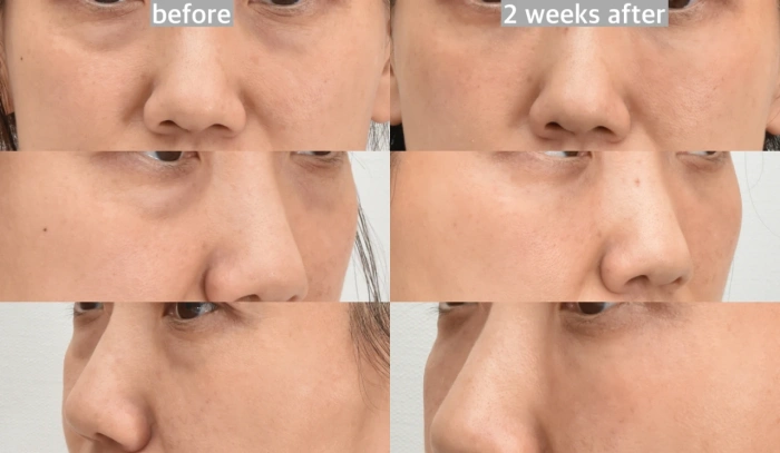 بعد أسبوعين من جراحة تجميل الجفن السفلي بدون ندبات وتجديد سطح الجلد بالليزر