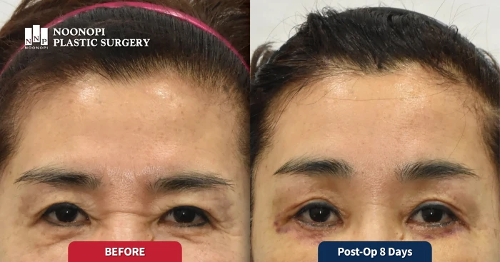 Before and after of a patient with low-set eyebrows 8 days after forehead lift
