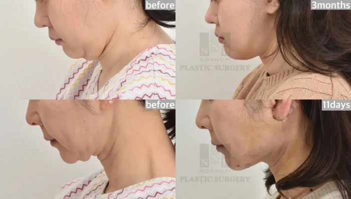 full neck lift before after results