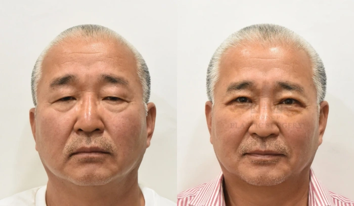 اليوم السابع بعد عملية تجميل الجفن العلوي