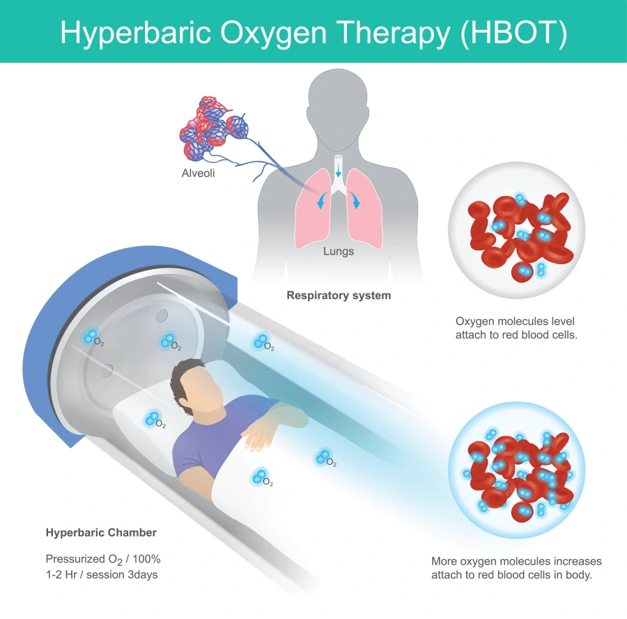 hyperbaric oxygen mechanism