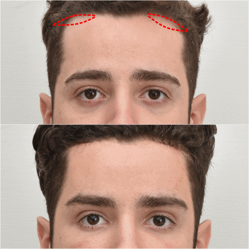 Noonopi Clinic's specialised Fox Eye Lift procedure