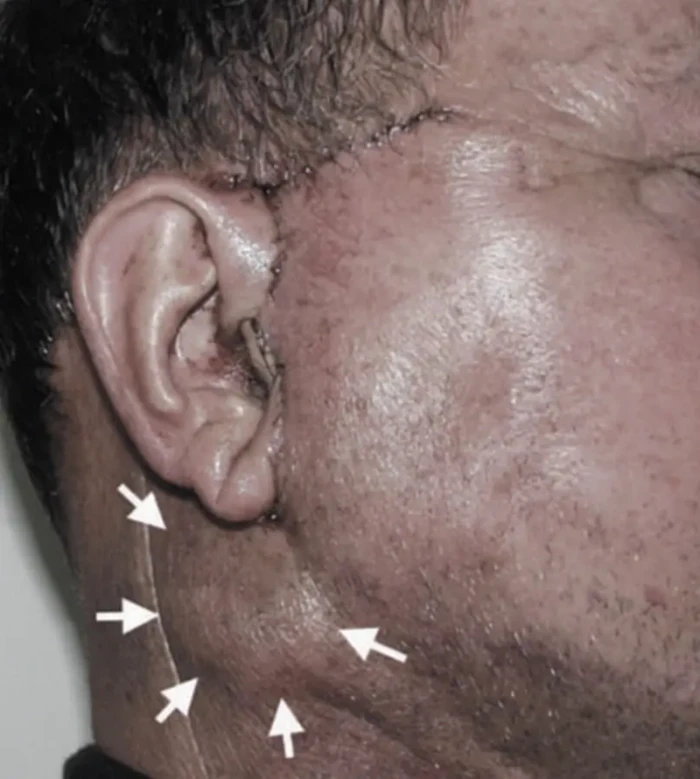 안면거상 부작용 혈종의 예시 사진