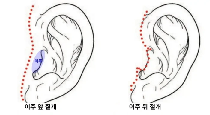 안면거상 연예인에게 추천되는 이주 뒤 절개 방법