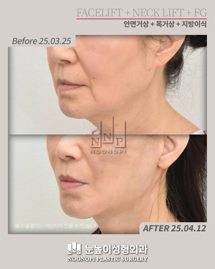 early post-op results of dual plane facelift in seoul clinic