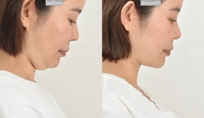 جراحة إزالة الزوائد اللحمية من الرقبة