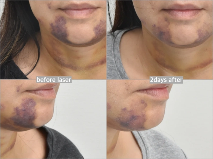 激光与高压氧治疗促进康复