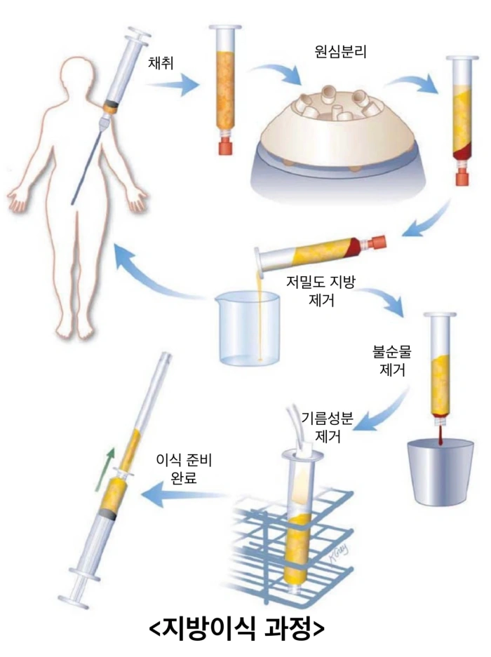 얼굴 지방이식 과정