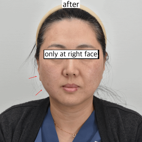 XERF提拉术前后对比照